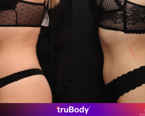 truSculpt vs. truBody: Which Body Contouring Treatment Is Right for You?