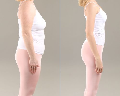 What is Non-Surgical Weight Loss?