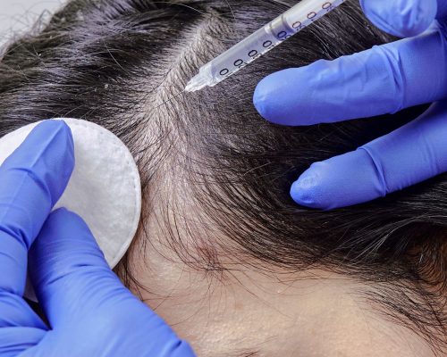 PRP for Hair: The Path to Thicker Locks